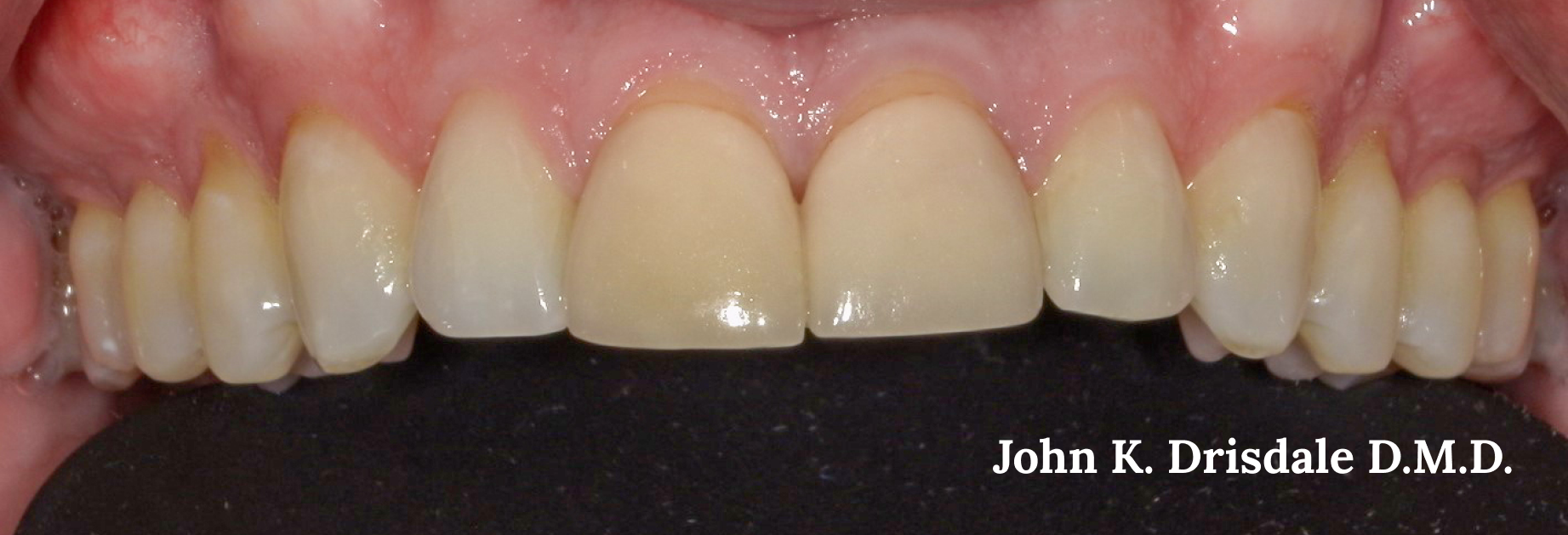 A close up of a person 's teeth taken by john k. driscole d.m.d.