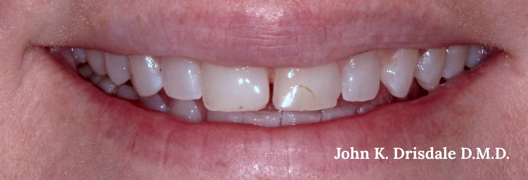 A close up of a person 's teeth with john k. driscole d.m.d. written on the bottom