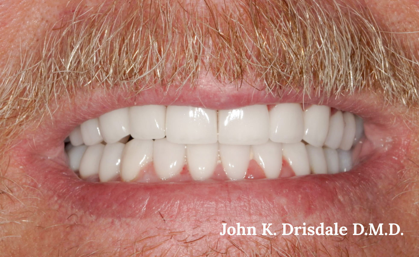 A close up of a man 's teeth by john k. driscole d.m.d.