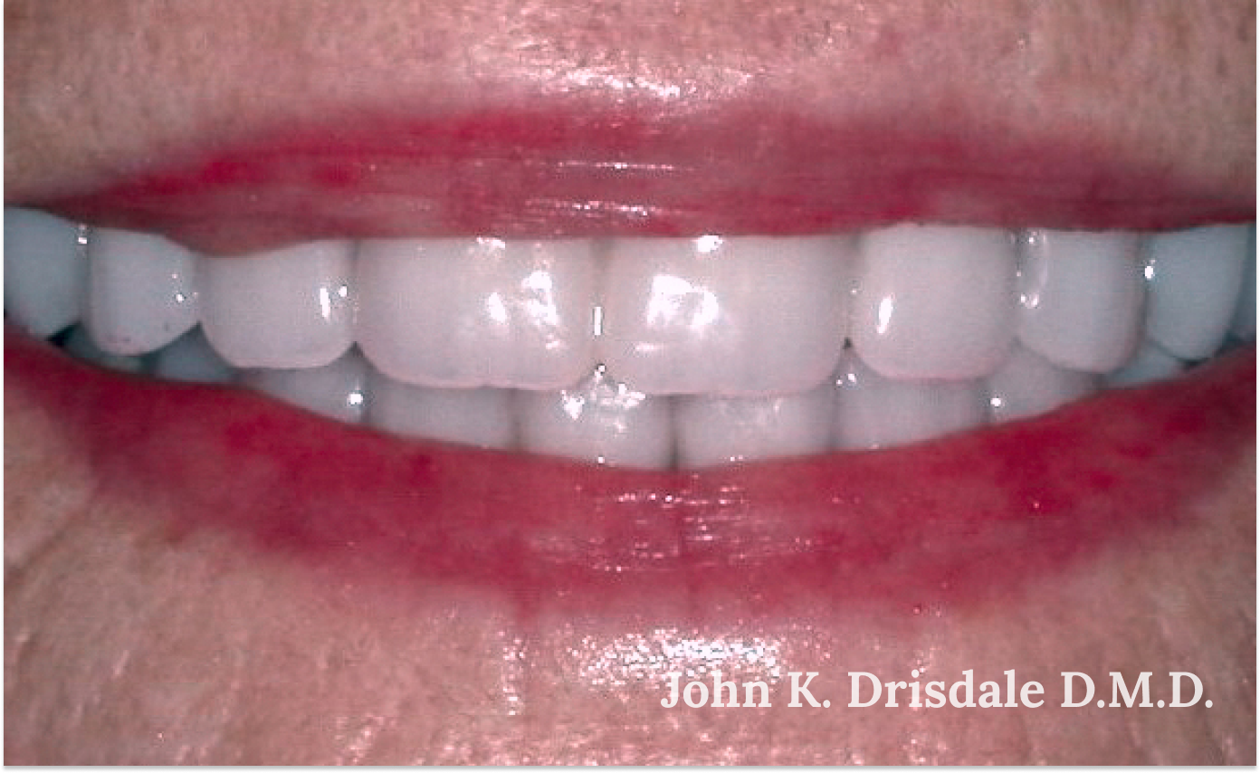 A close up of a woman 's teeth taken by john k. driscole d.m.d.