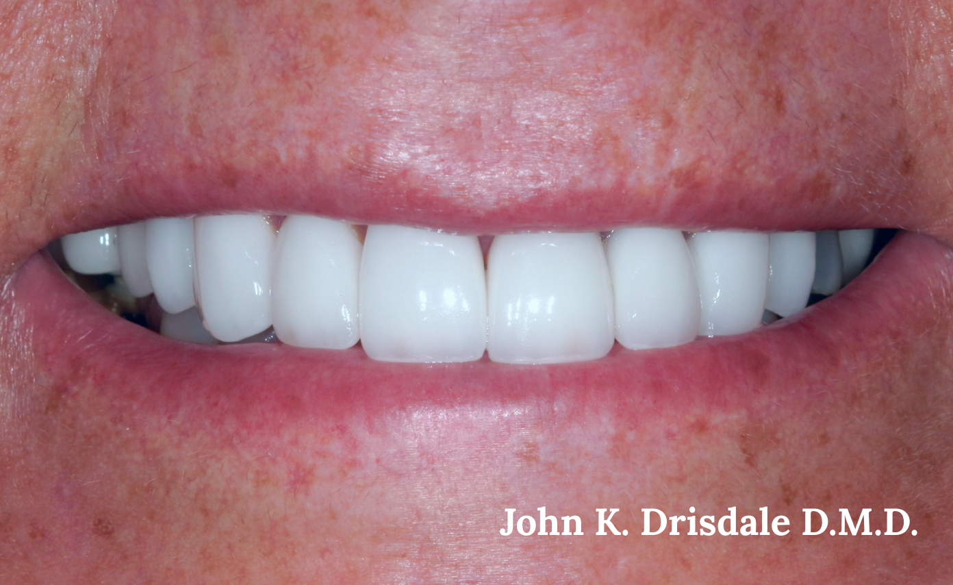 A close up of a person 's teeth by john k. driscole d.m.d.