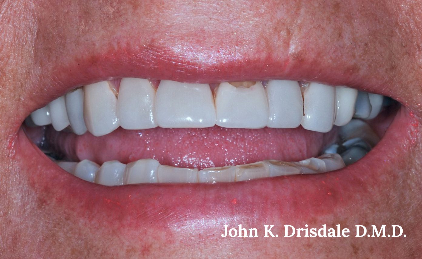 A close up of a person 's teeth taken by john k. driscole d.m.d.