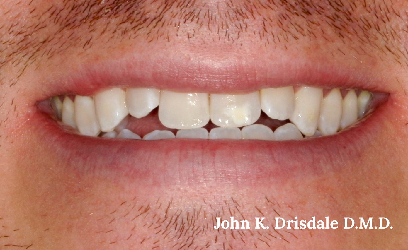 A close up of a man 's mouth with a beard and white teeth.