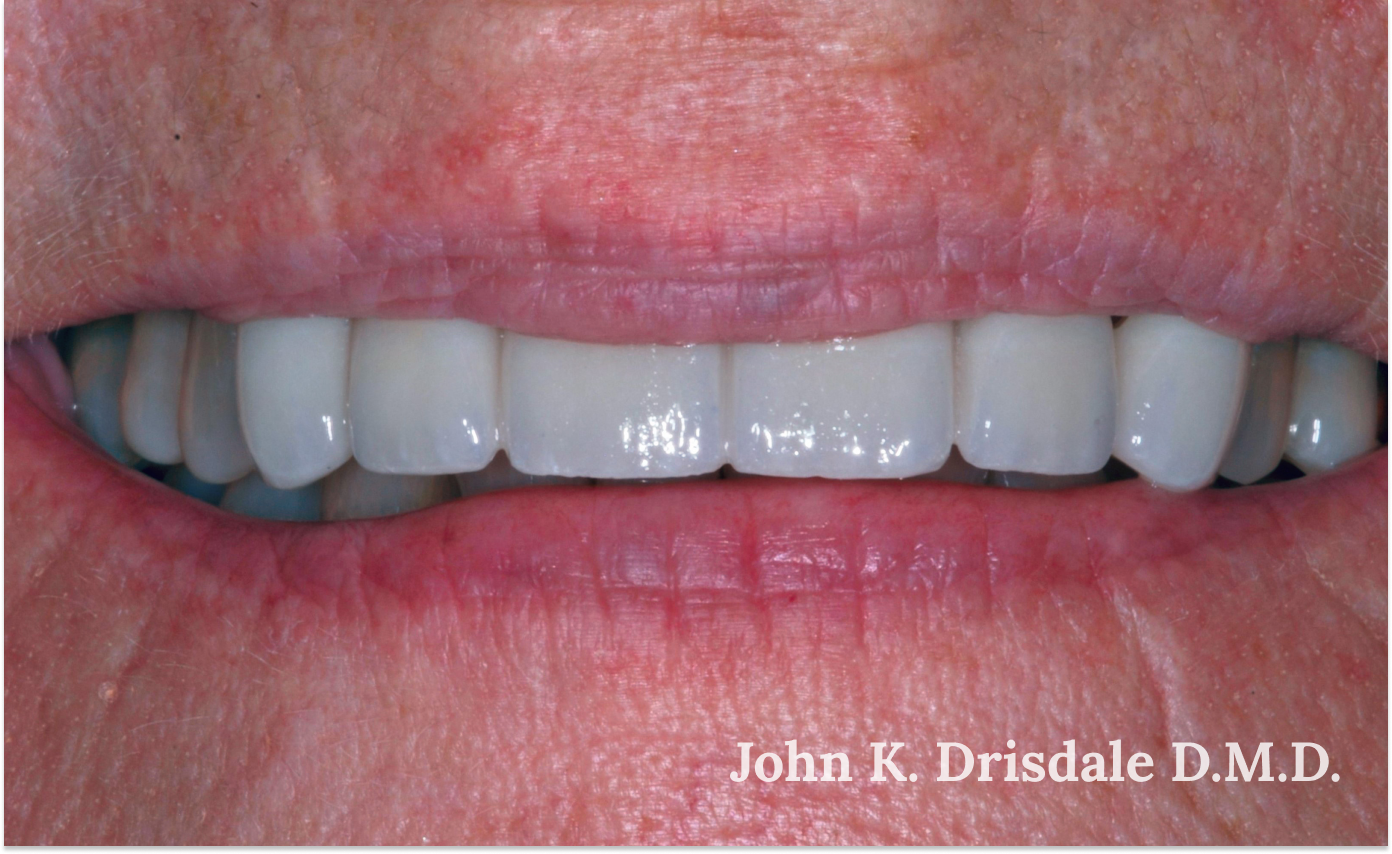 A close up of a person 's teeth by john k. driscole d.m.d.