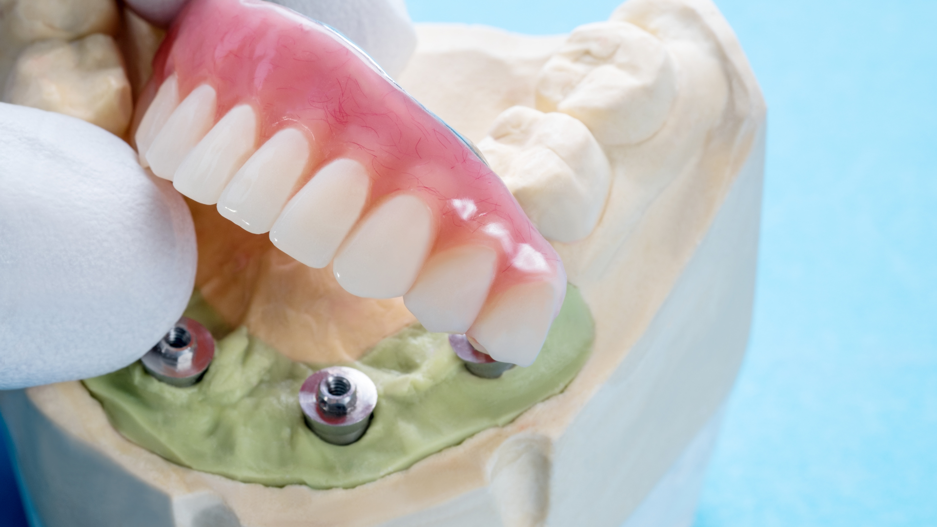 a close up of a denture on a model of a person 's teeth .
