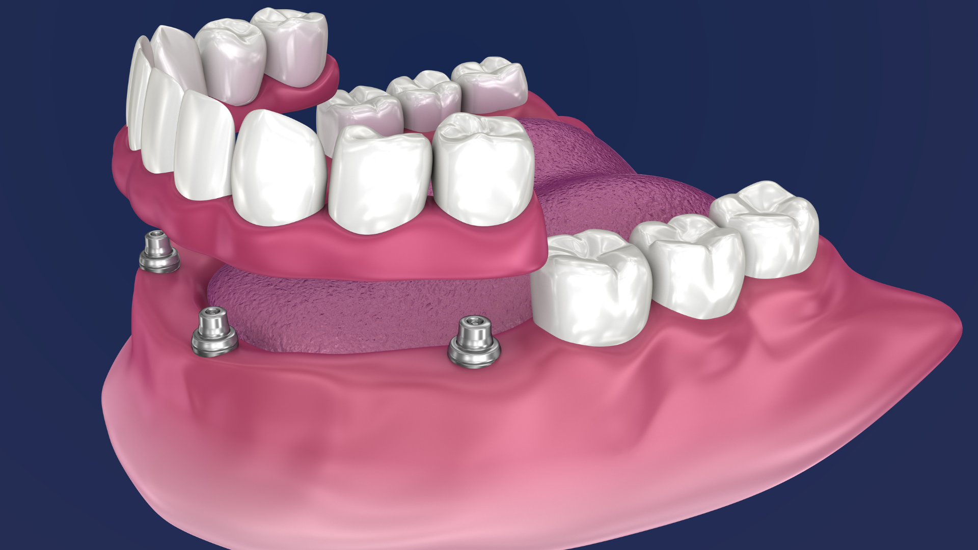 a computer generated image of a All on 4 dental implnats with a blue background .
