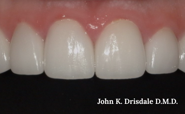 A close up of a person 's teeth by john k. driscoll d.m.d.