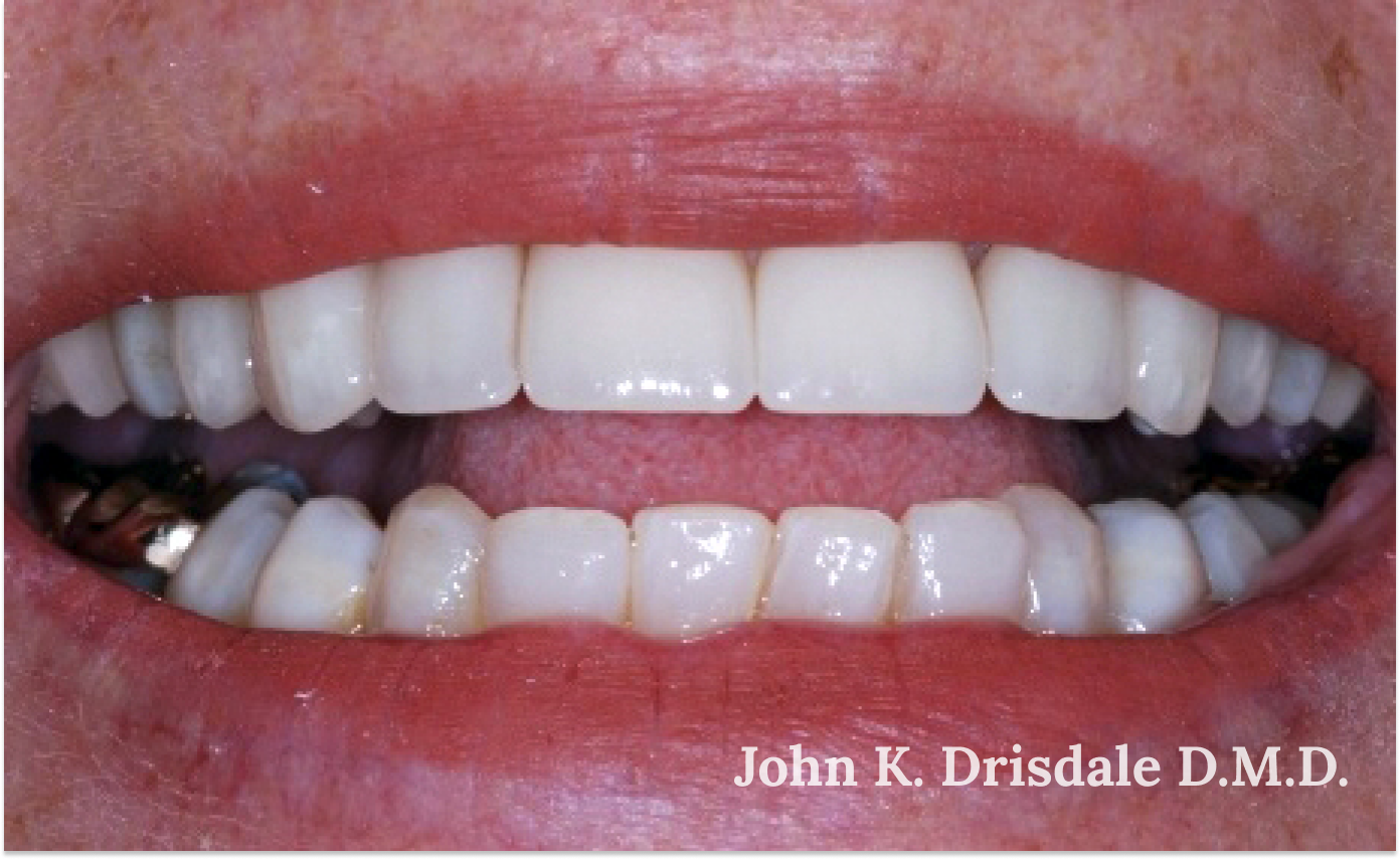 A close up of a person 's teeth by john k. driscole d.m.d.