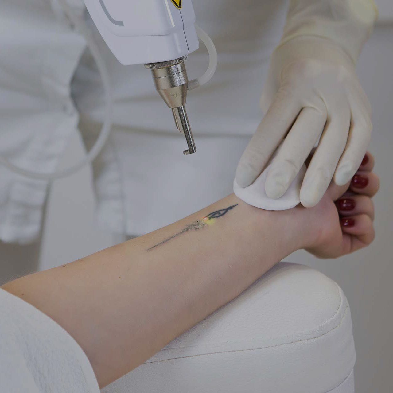 A woman is getting a tattoo removed from her arm
