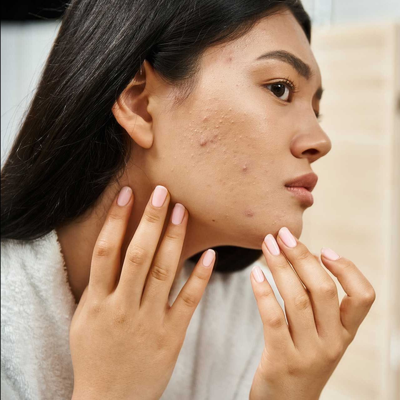 young asian woman with brunette hair examining her skin with acne in the mirror, skin issue
