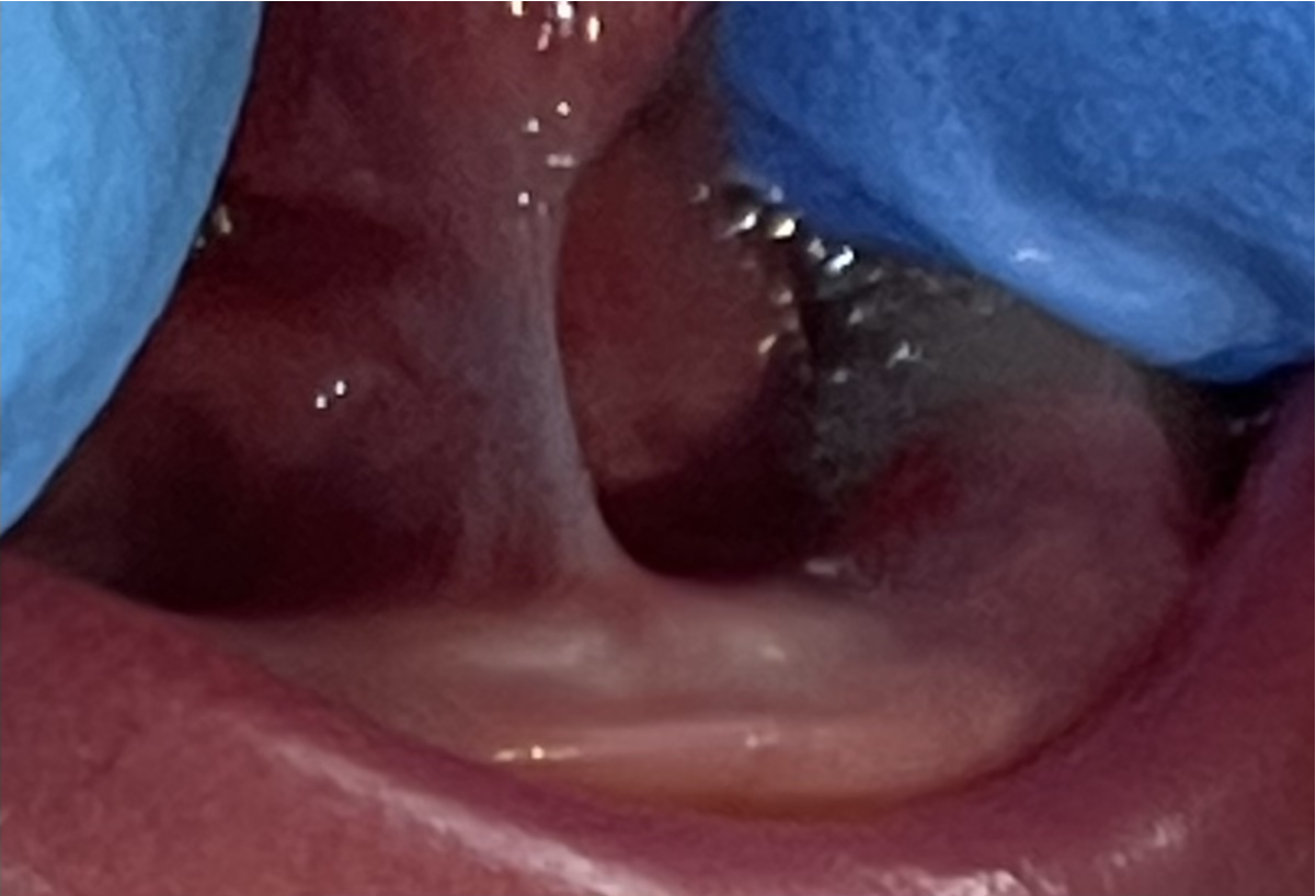 a close up of a person 's mouth with a blue glove on .