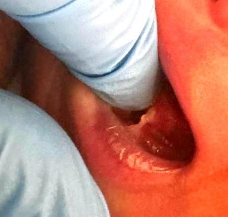 a close up of a person 's mouth with a glove on .