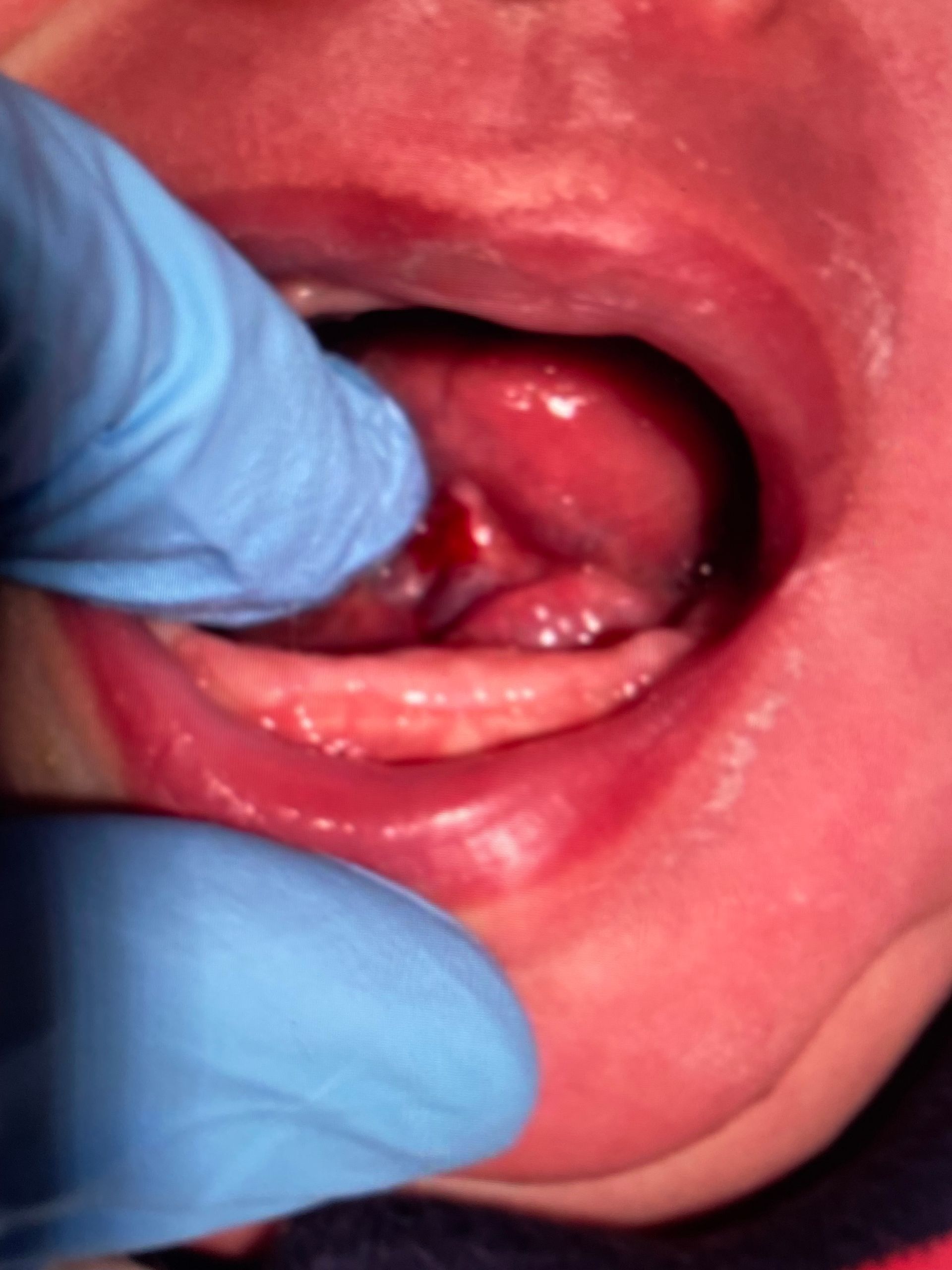 a close up of a baby 's mouth with blue gloves on
