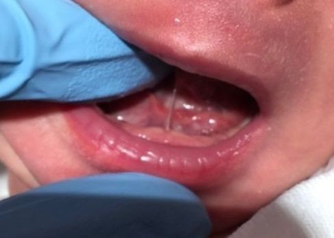 a close up of a baby 's mouth with blue gloves on
