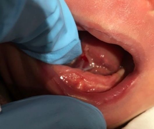 a close up of a baby 's mouth with blue gloves on