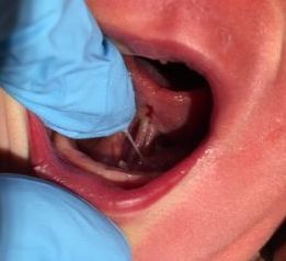 a close up of a baby 's mouth with blue gloves on