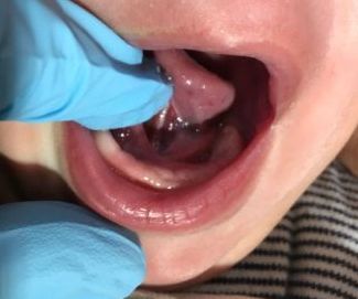 a close up of a baby 's mouth with blue gloves on