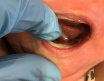 a close up of a baby 's mouth with blue gloves on