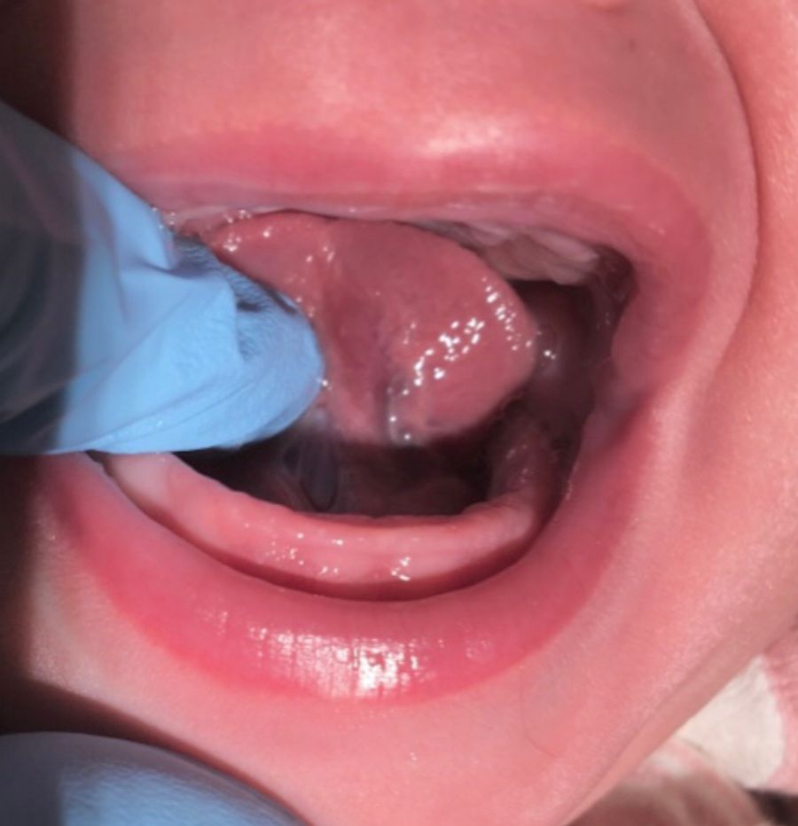 a close up of a baby 's mouth with a blue glove on