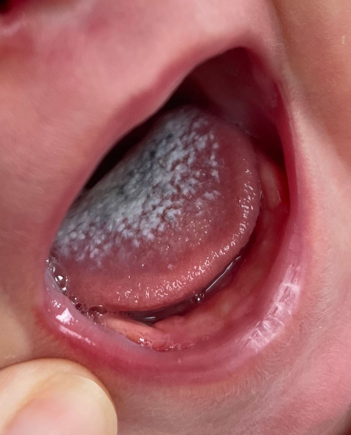 a close up of a baby 's tongue with white spots on it