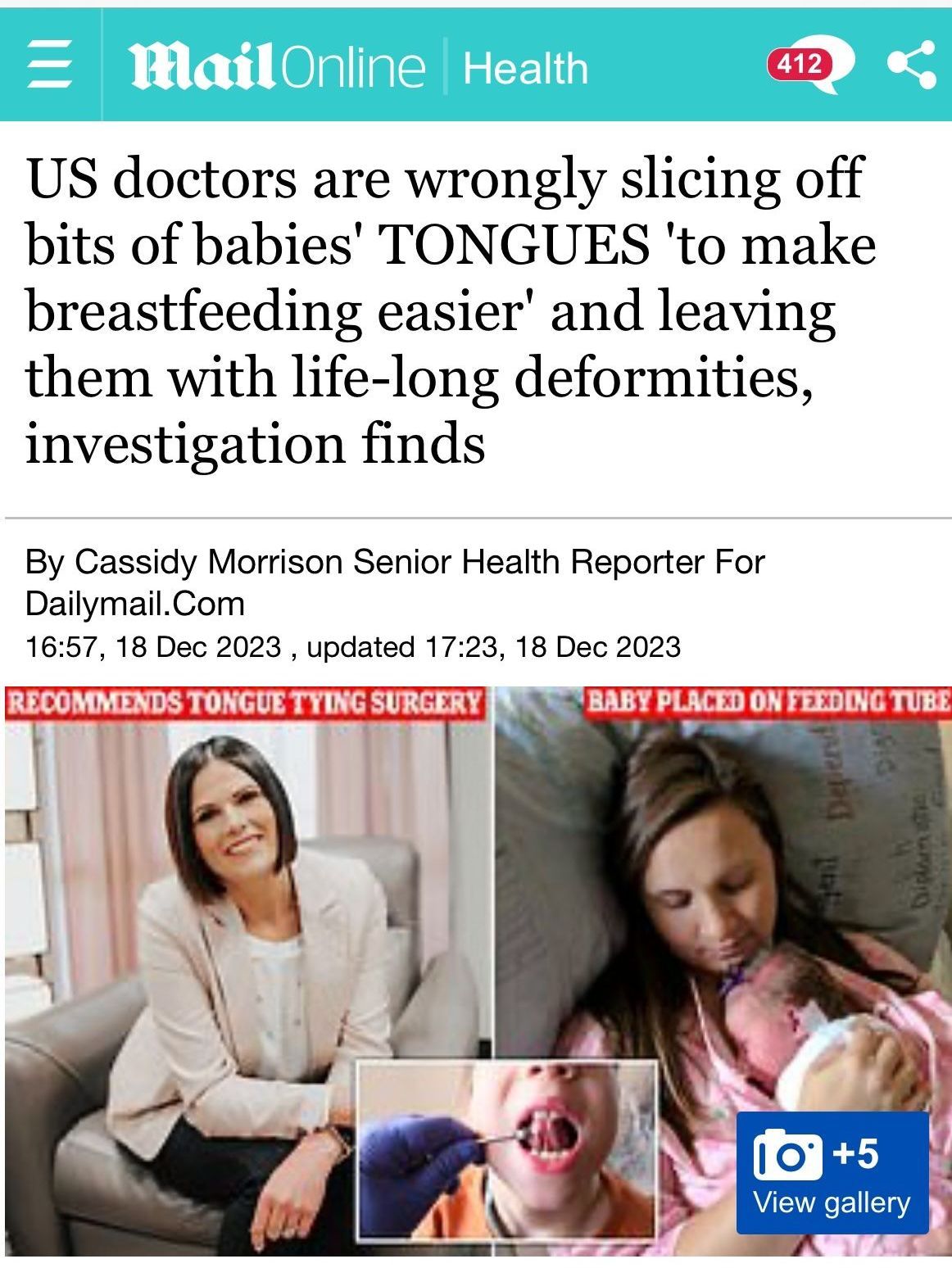 us doctors are wrongly slipping off bits of babies ' tongues to make breastfeeding easier