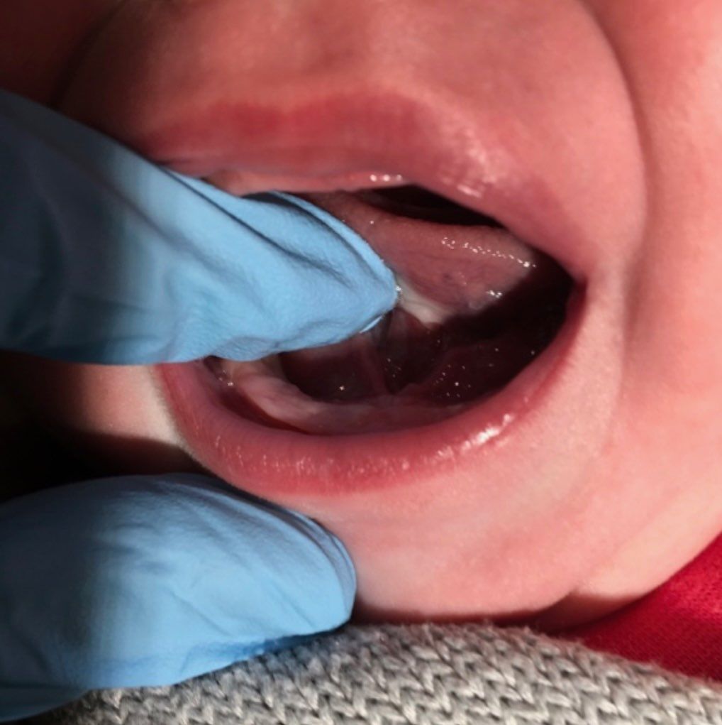 a close up of a baby 's mouth with blue gloves on
