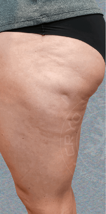 Body contouring in Glendale, AZ