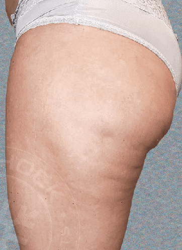 THE BEST 10 Body Contouring in GLENDALE, AZ - Last Updated January 2024 -  Yelp