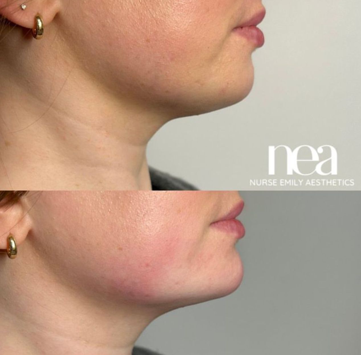 A before and after photo of a woman 's neck by nea nurse emily aesthetics