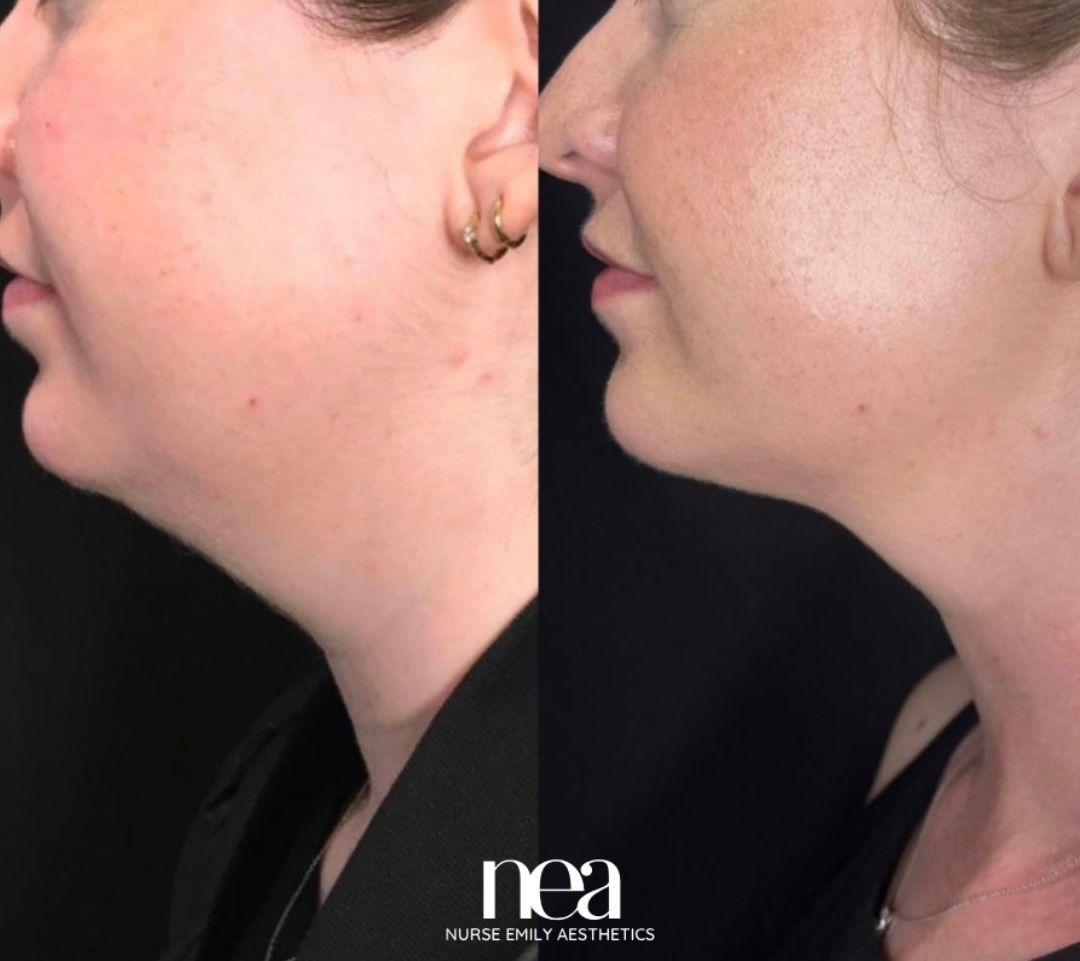 A before and after photo of a woman 's face and neck by nea