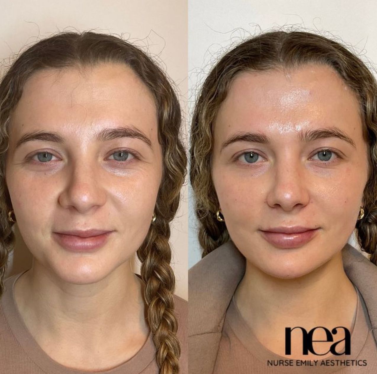A before and after photo of a woman 's face by nea nurse emily aesthetics