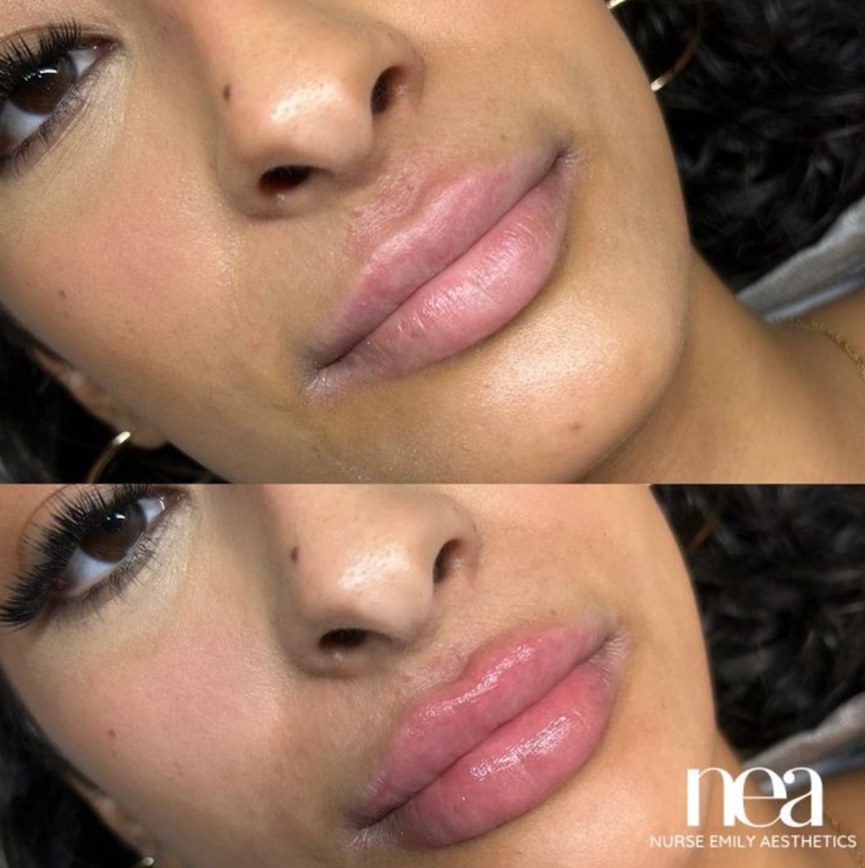 A before and after photo of a woman 's lips by nea nurse emily aesthetics