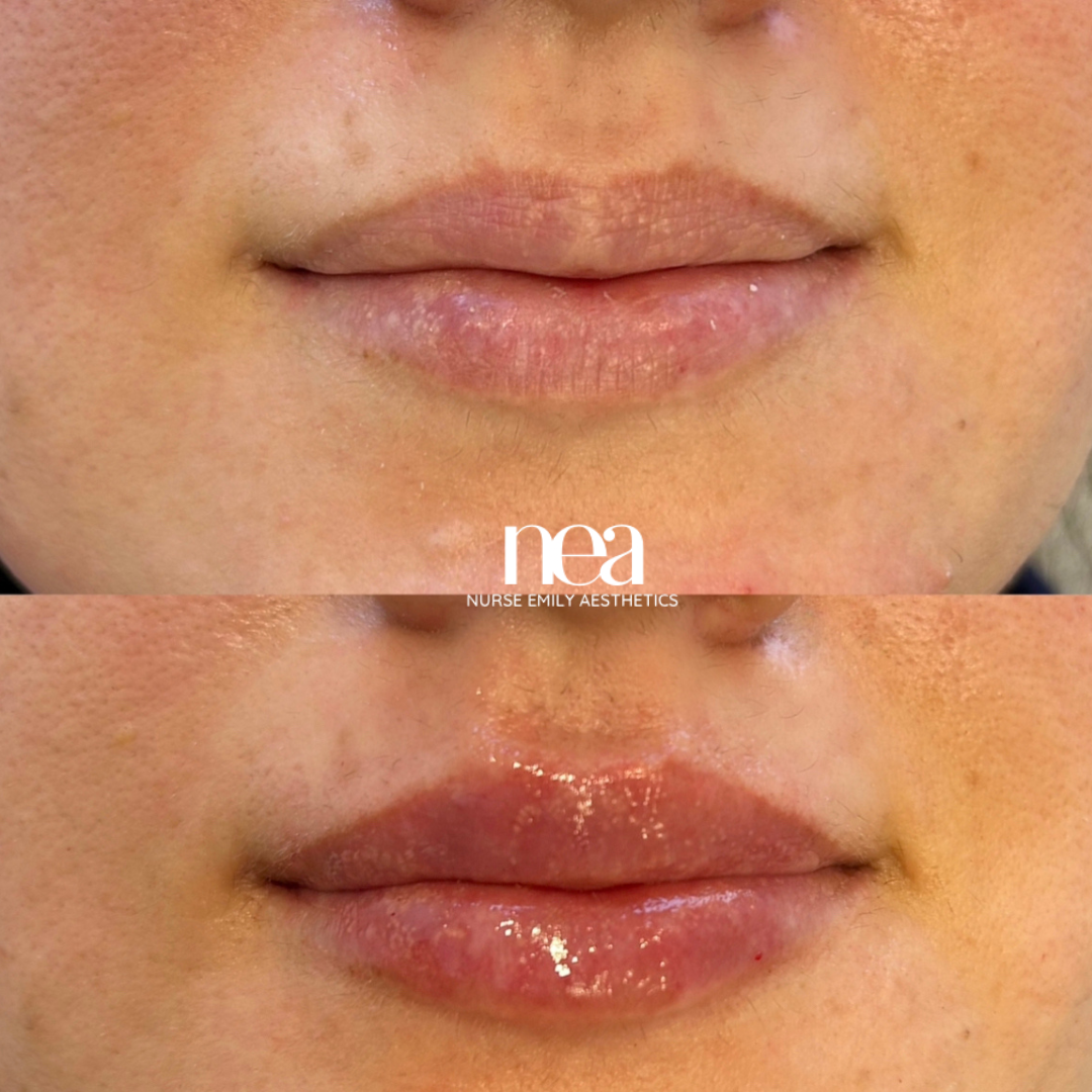 A before and after photo of a woman 's lips.