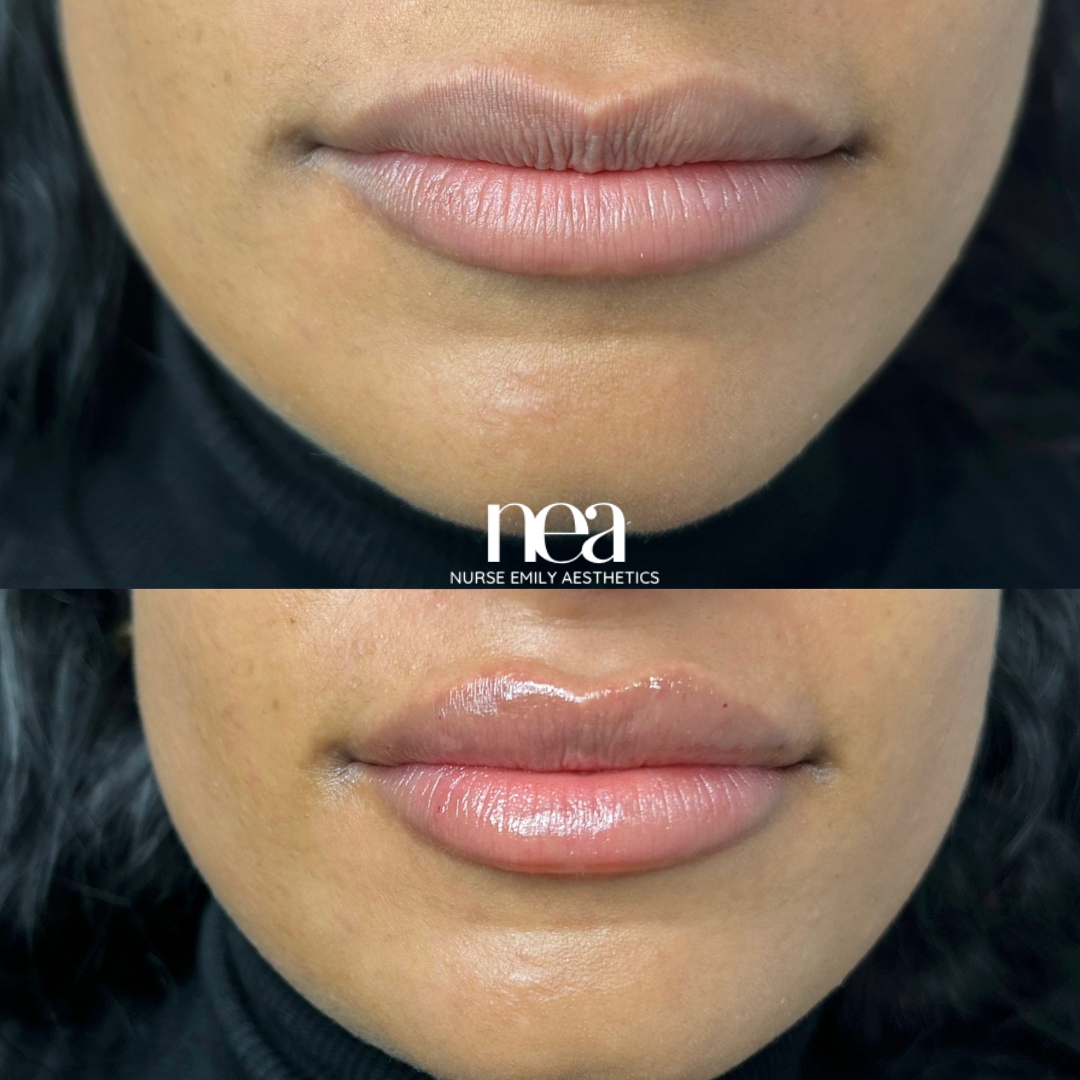 A before and after photo of a woman 's lips.