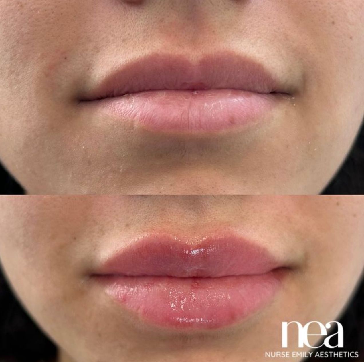 A before and after photo of a woman 's lips by nea nurse only aesthetics