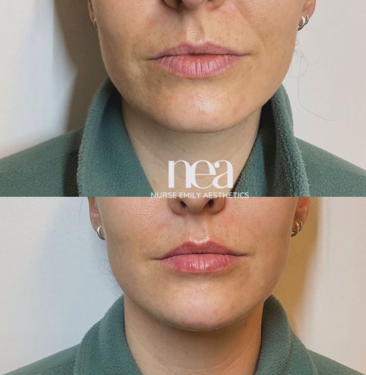 A before and after photo of a woman 's face by nea