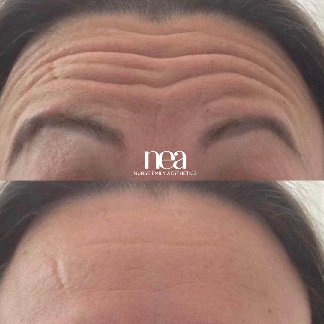 A woman 's forehead is shown before and after botox injections.