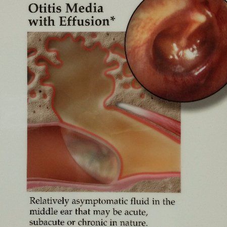 Medical diagram of an otitis media with effusion