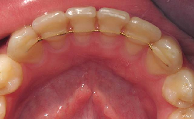 Retainer aus Draht