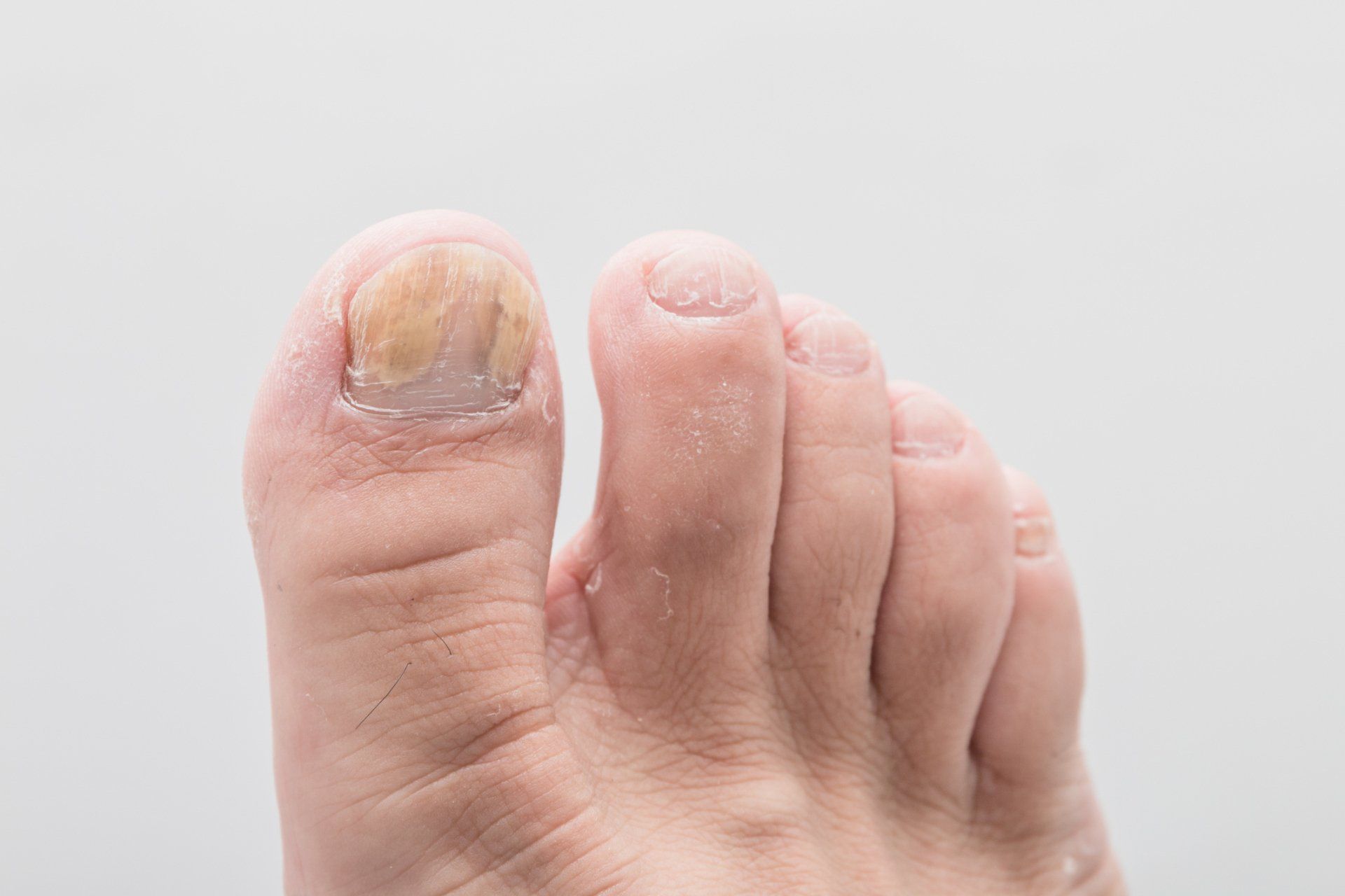 Fungal Nail Infections — Brisbane, Qld — McLean & Partners Podiatrists