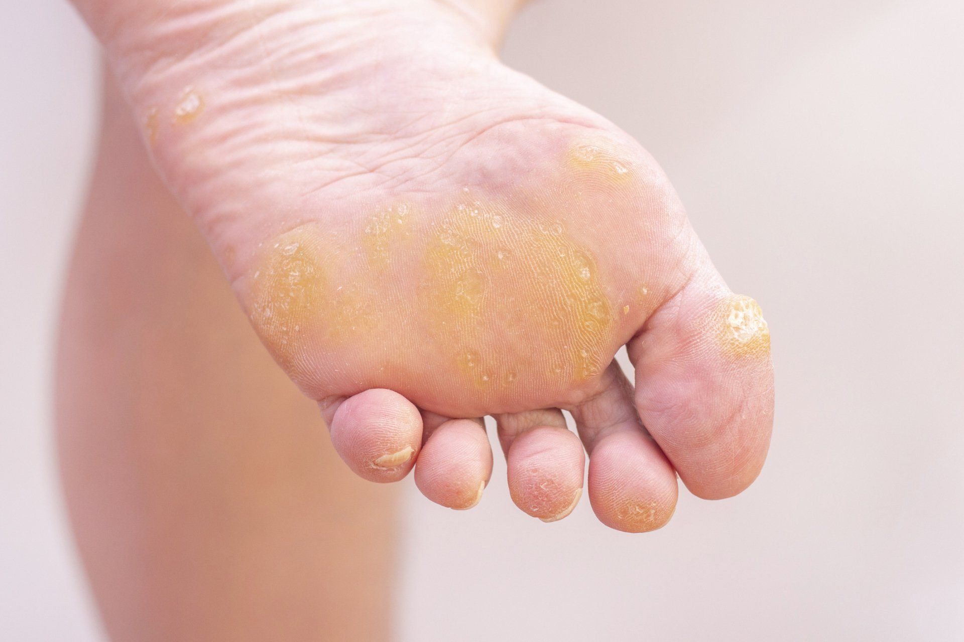 Corns on Foot — Brisbane, Qld — McLean & Partners Podiatrists