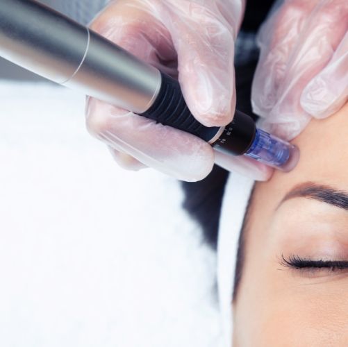 Microneedling in Prospect CT