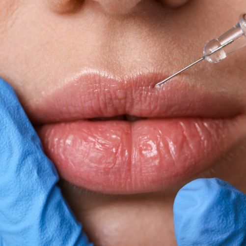 Fillers Lips and Cheeks in Prospect CT