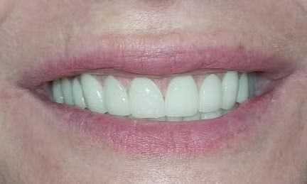 Close-up of a person's smiling mouth showing bright white, evenly spaced teeth and pink lips.