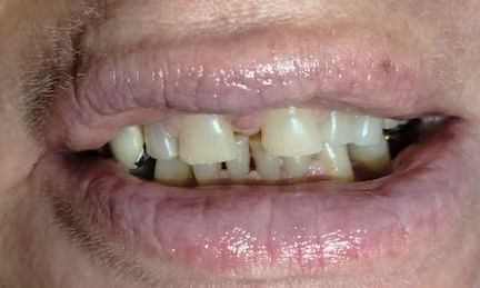 Close-up of a person's mouth showing misaligned, yellowed teeth; lips are glossy and slightly parted.