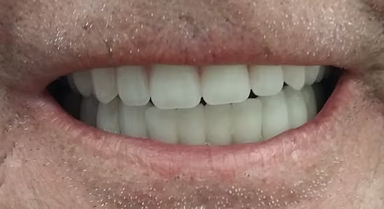 Close-up of a person's smiling mouth showing a row of straight, white teeth. Pink gums and skin visible.