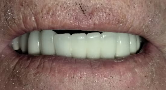 Close-up of a person's mouth showing a set of artificial teeth. The skin around the lips is visible.