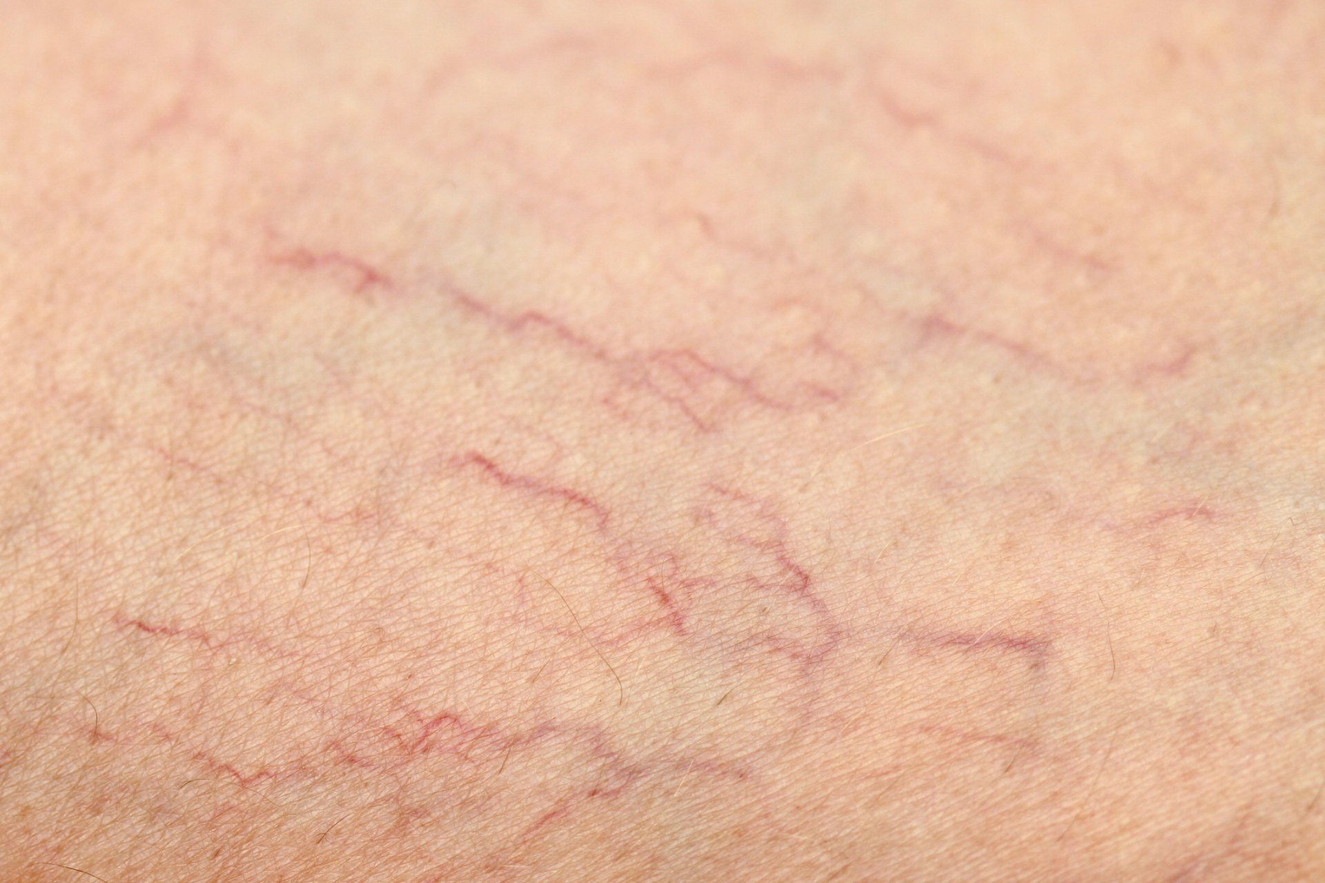 Leg with Spider Vein — Irving, TX — Dr. Reddy Medspa