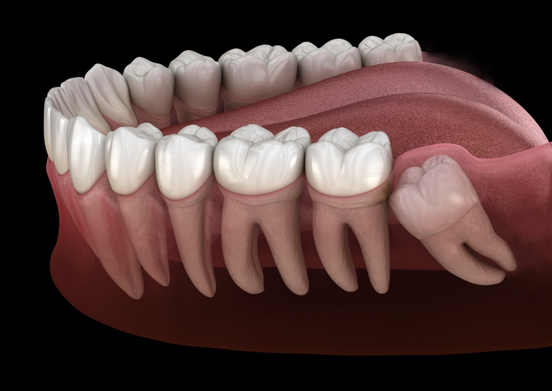 Impacted wisdom teeth model