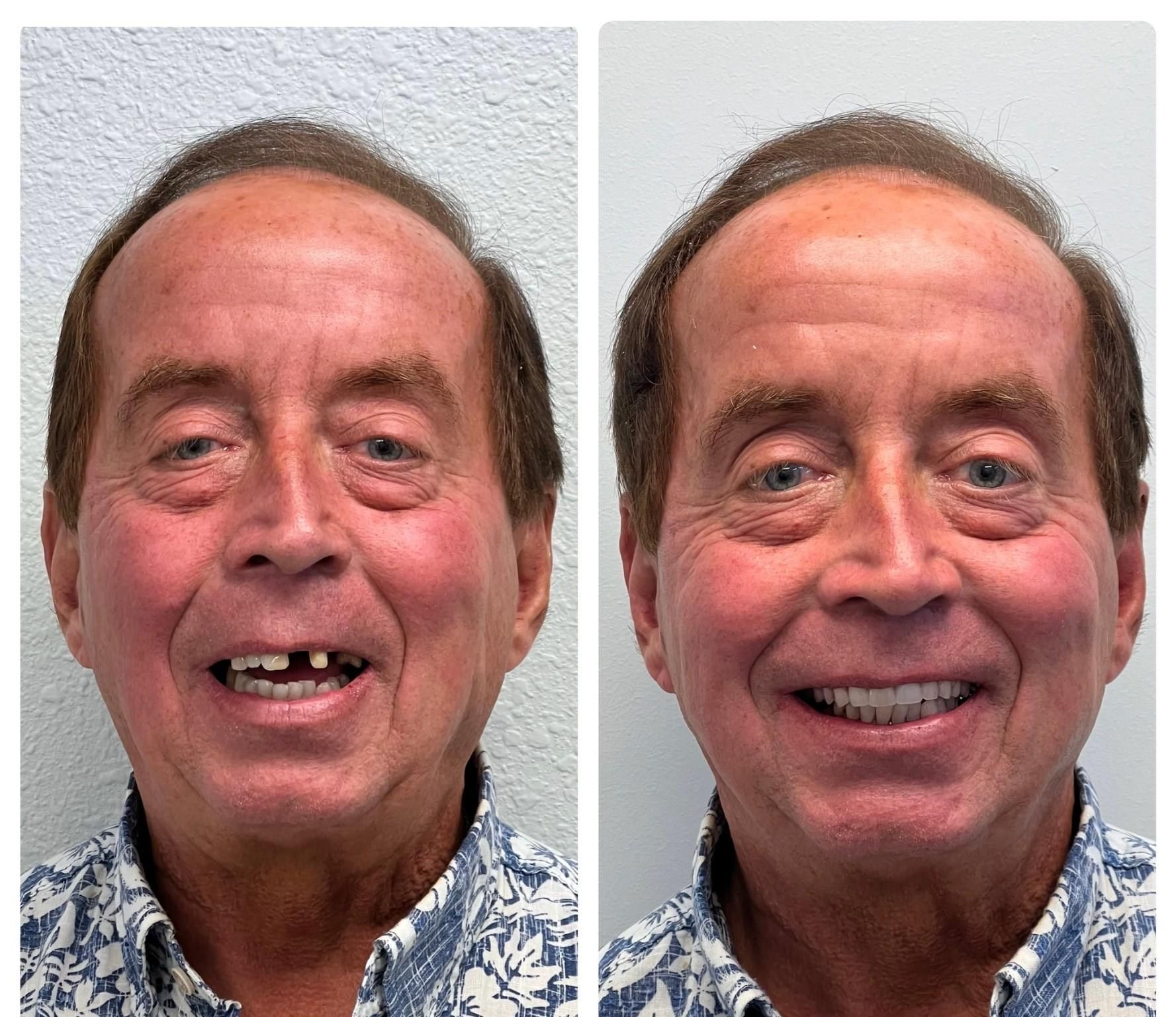 Fixed All On 4 implants before and after image